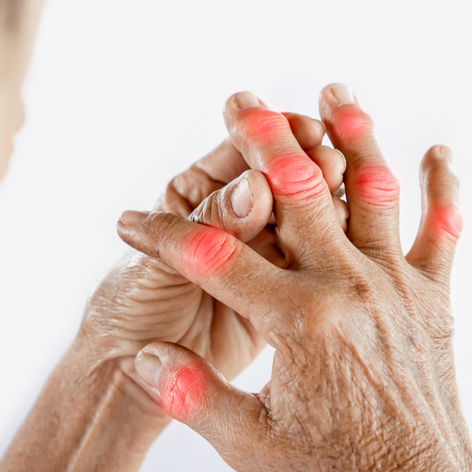 Arthritis