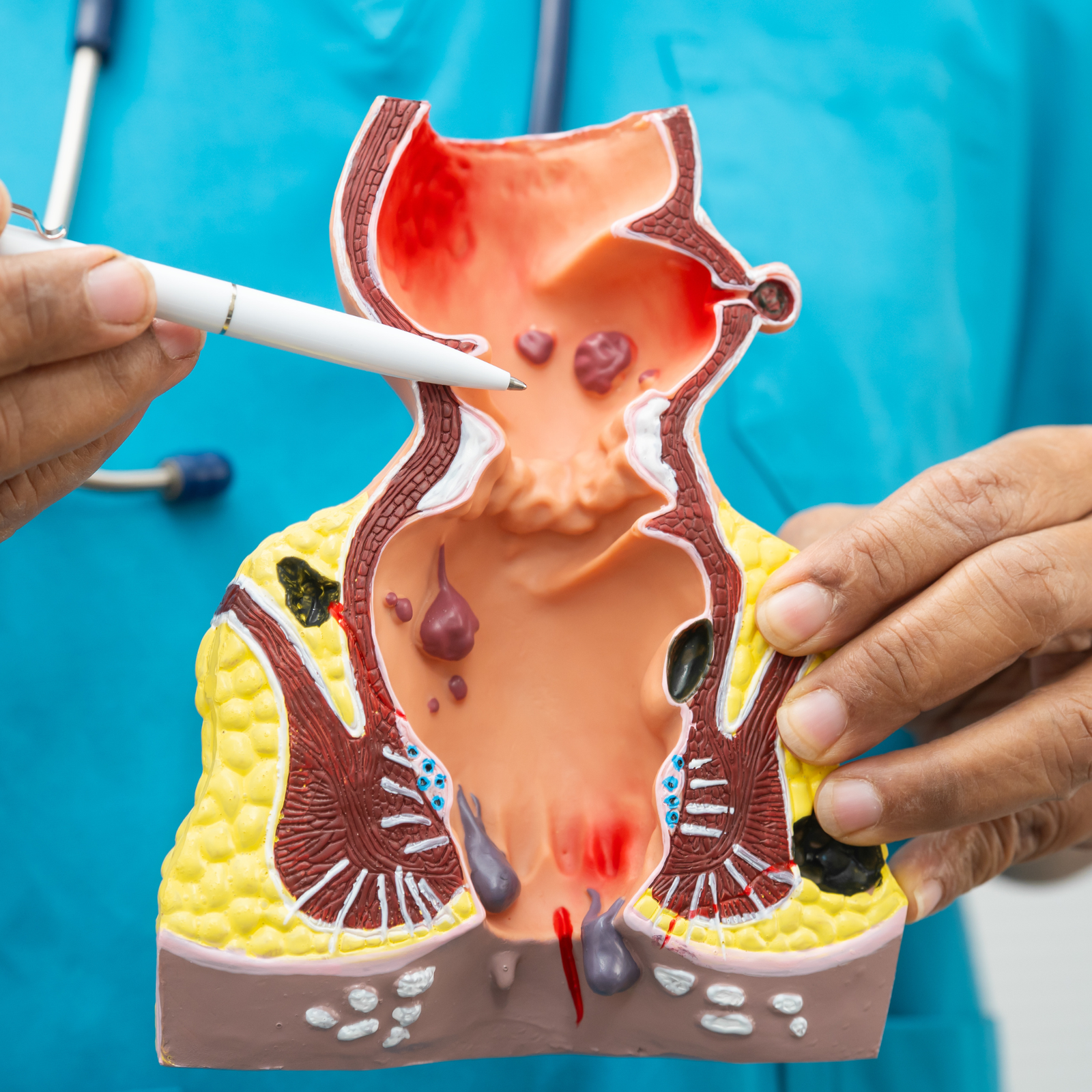 Piles (Haemorrhoids)