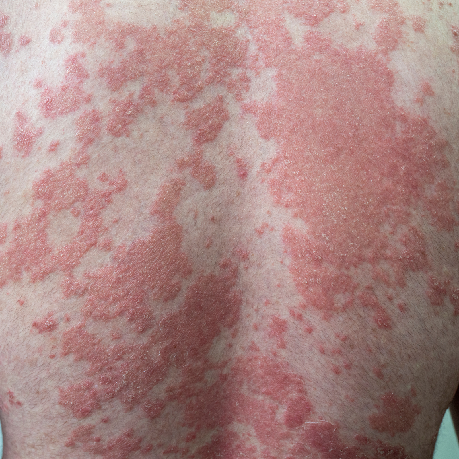 Psoriasis