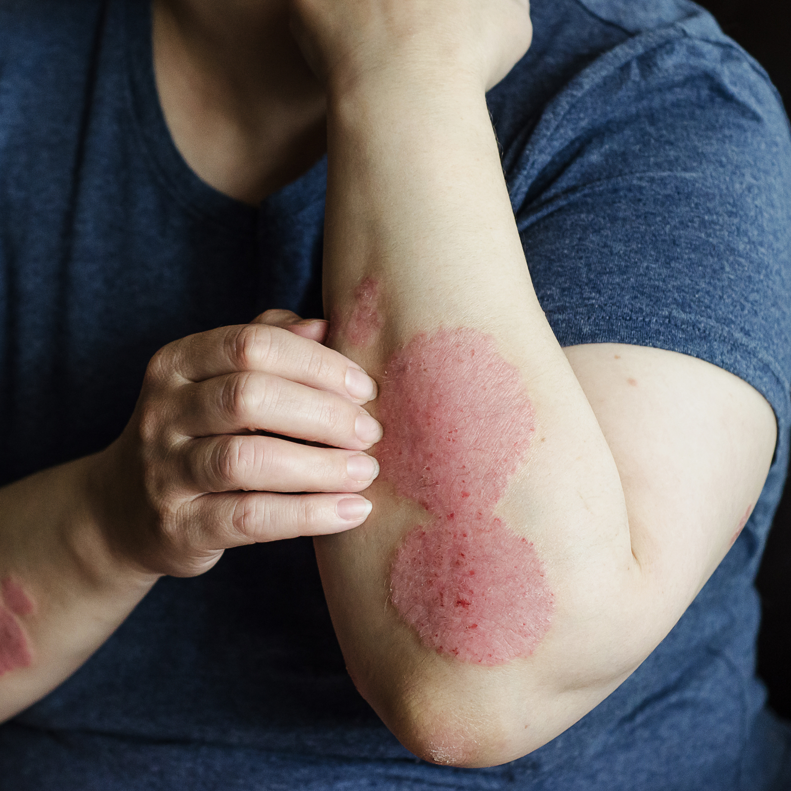 Eczema